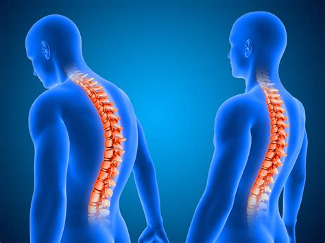 гръбначна артроза на гръбначния стълб